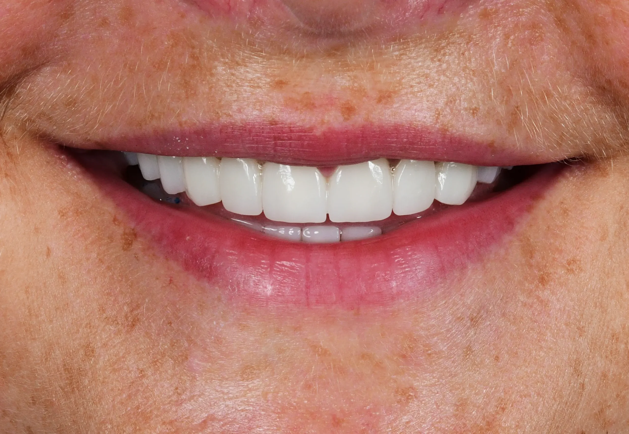 All On 4 Treatment — After