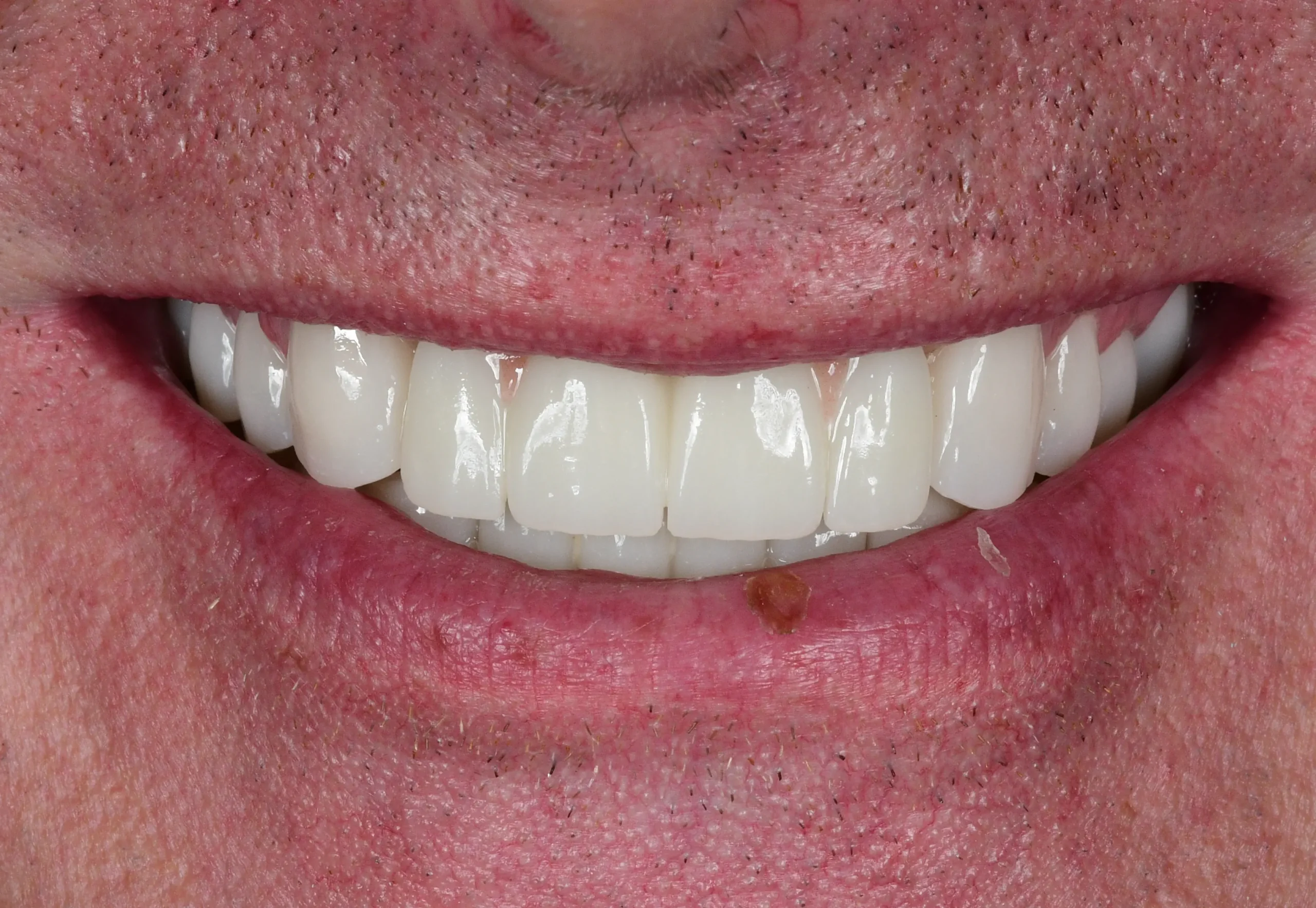 All On 6 Treatment — After