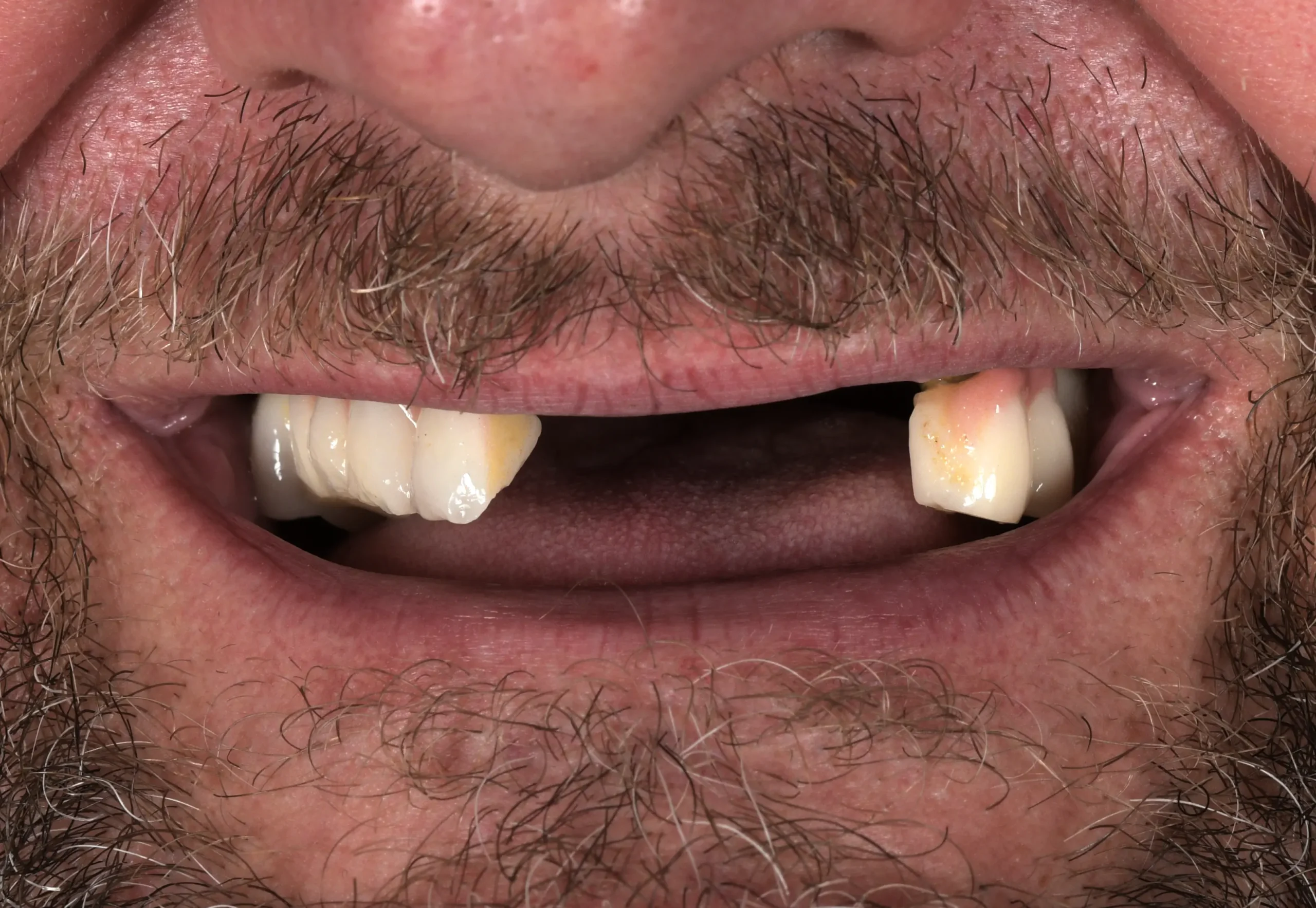 All On 4 Treatment — Before