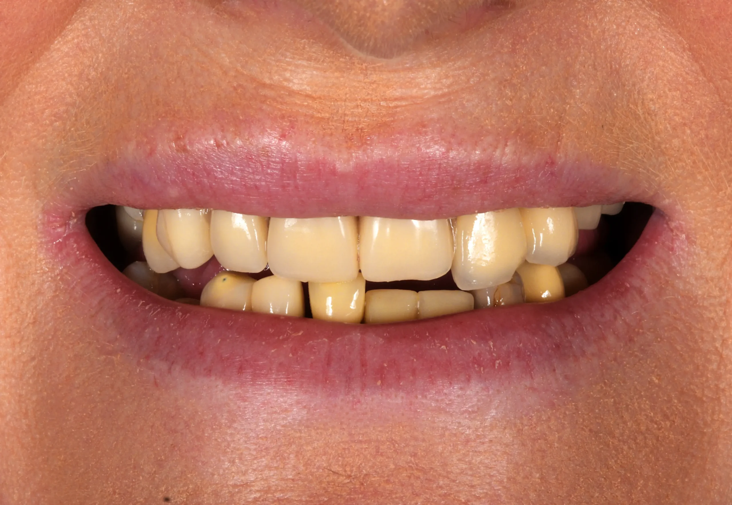 All On 6 Treatment — Before