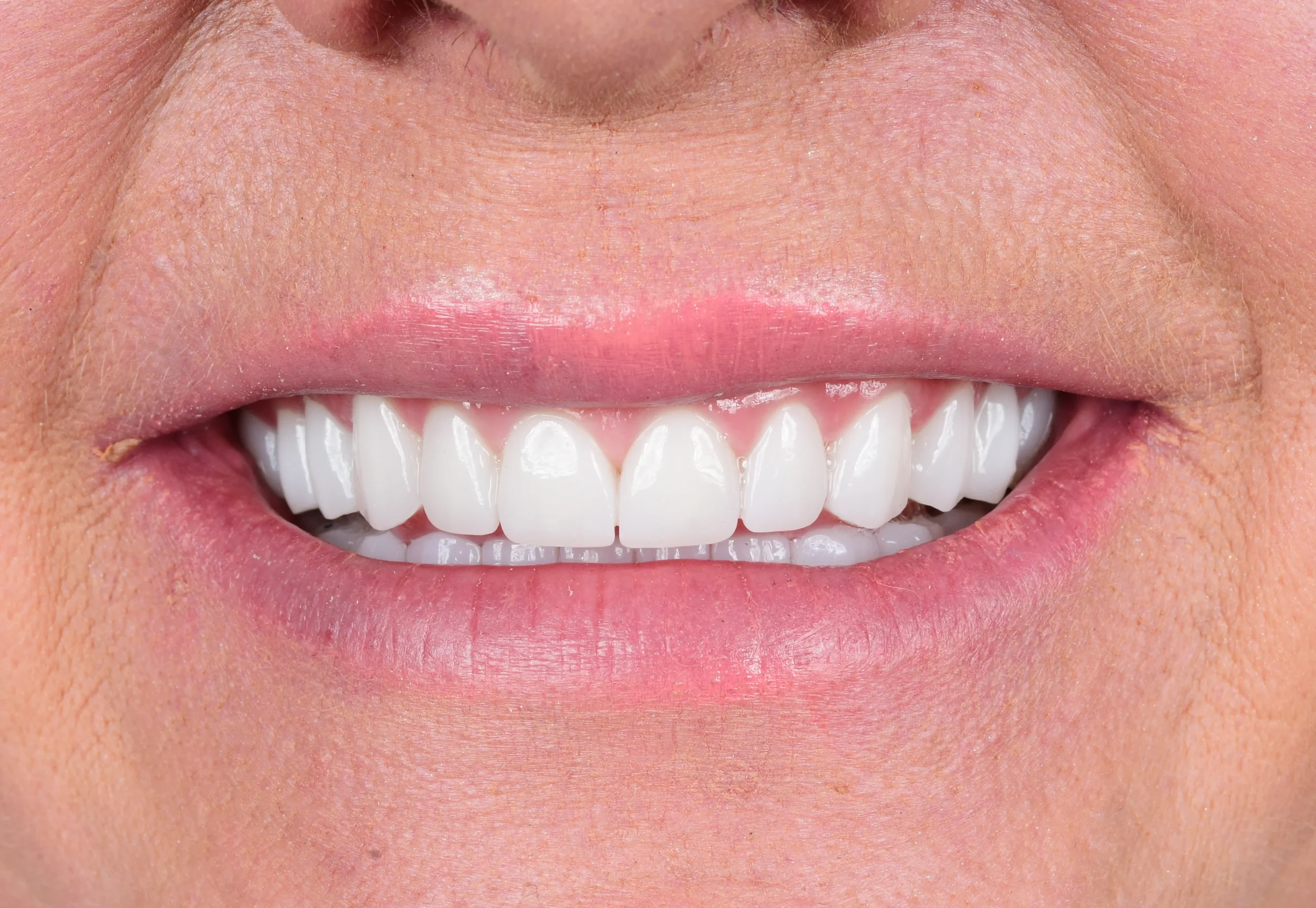 Hollywood Smile Makeover — After