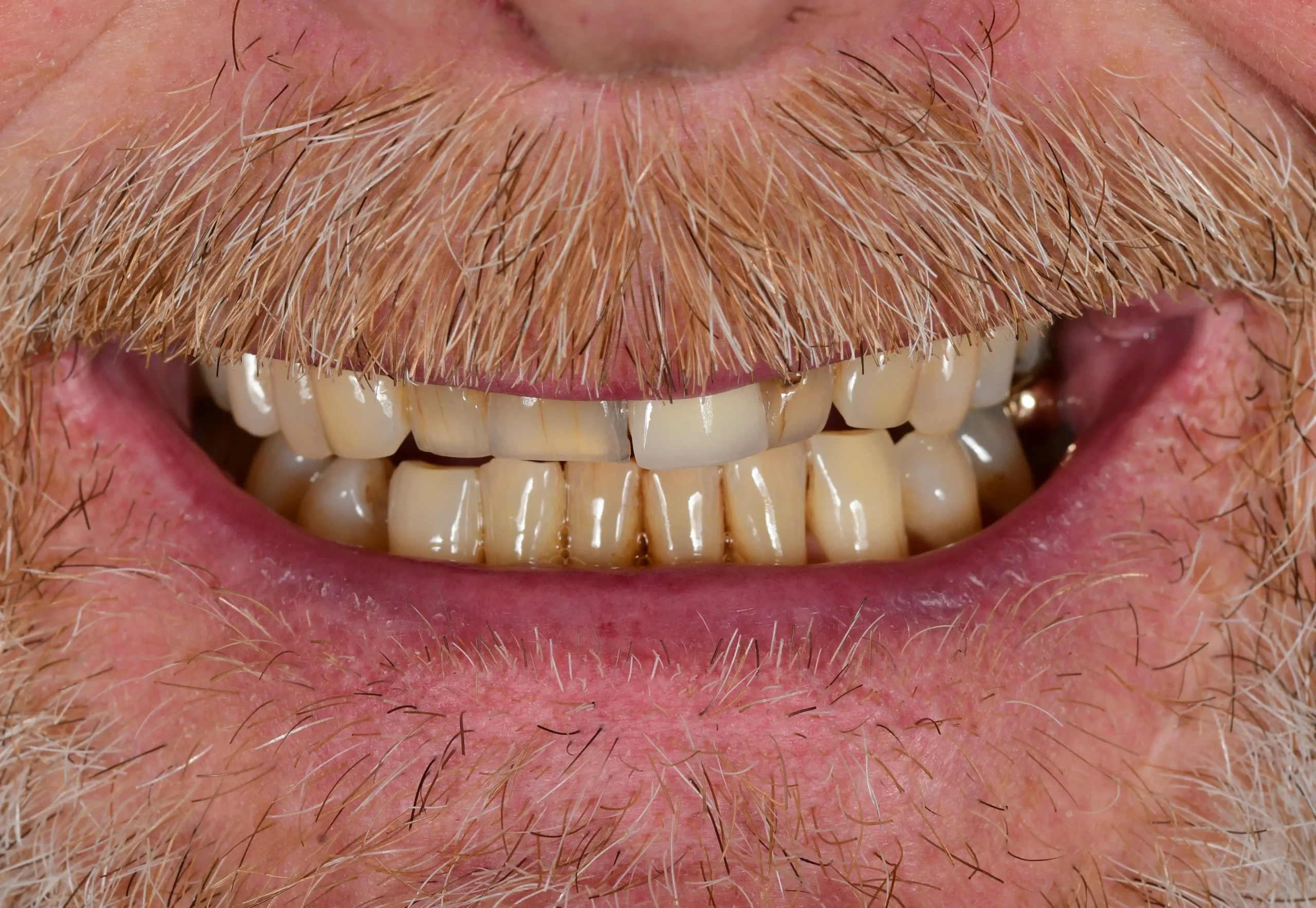 Natural Smile Makeover — Before