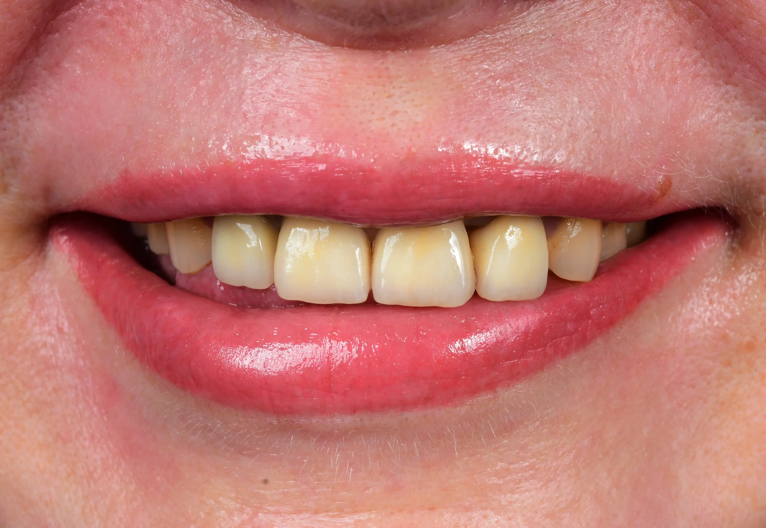 Natural Smile Make Over — Before