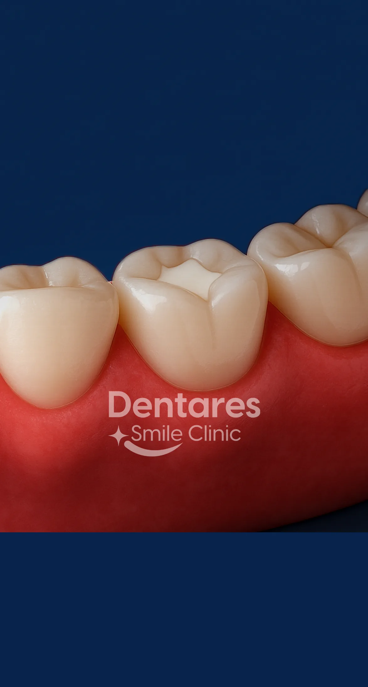White Composite Filling